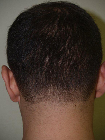 Back Hairline