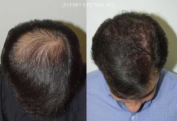 Hair Transplants For Men Photos Miami FL Patient37962