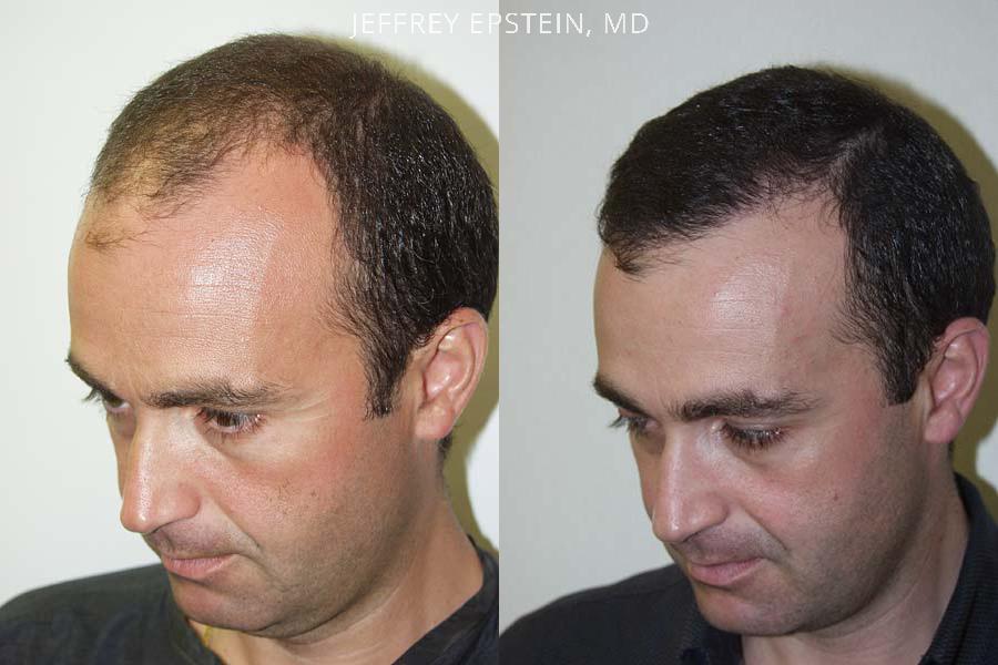 Hair Transplants For Men Photos Miami FL Patient38524