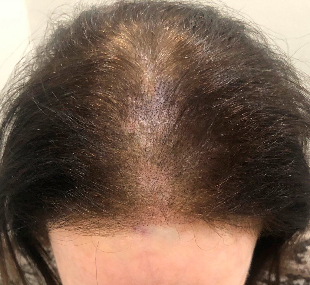 Micropigmentación del Cuero Cabelludo Scalp Micropigmentation Miami FL