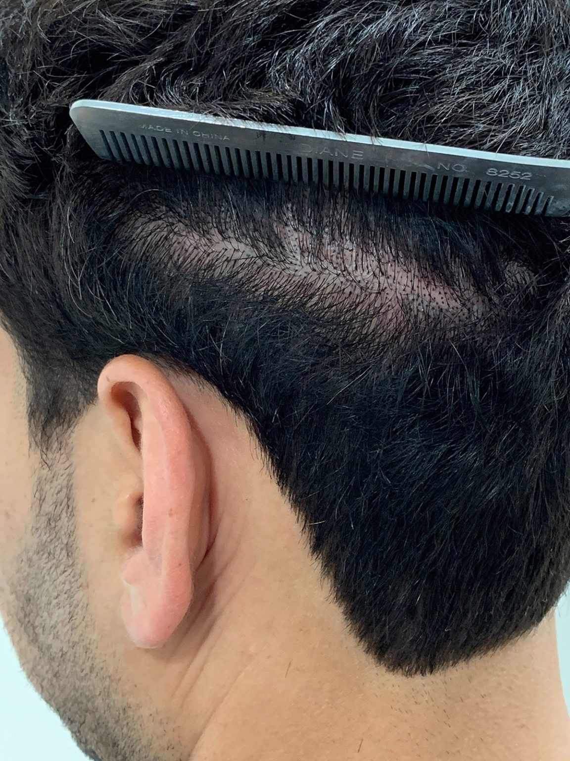 Micropigmentación del Cuero Cabelludo Scalp Micropigmentation Miami FL