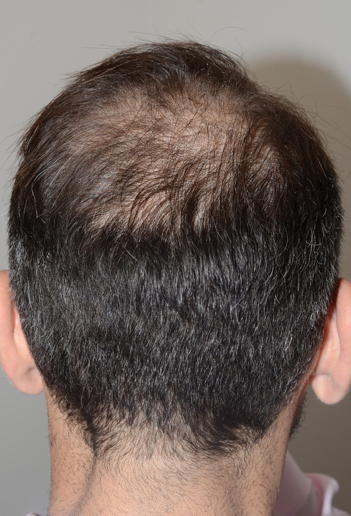 Micropigmentación del Cuero Cabelludo Scalp Micropigmentation Miami FL