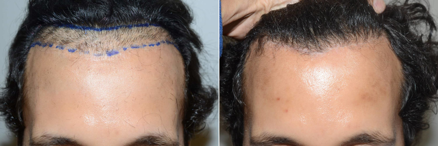 Hair Transplants For Men Reparative Hair Transplant Photos Miami Fl