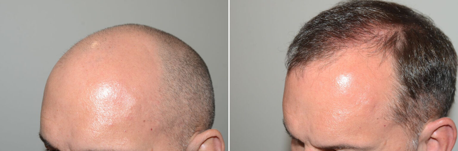 Hair Transplants For Men Photos Miami Fl Patient