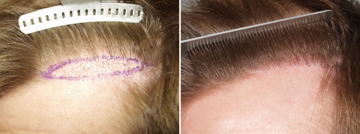 Reparative Hair Transplant Before And After Photos Page Of
