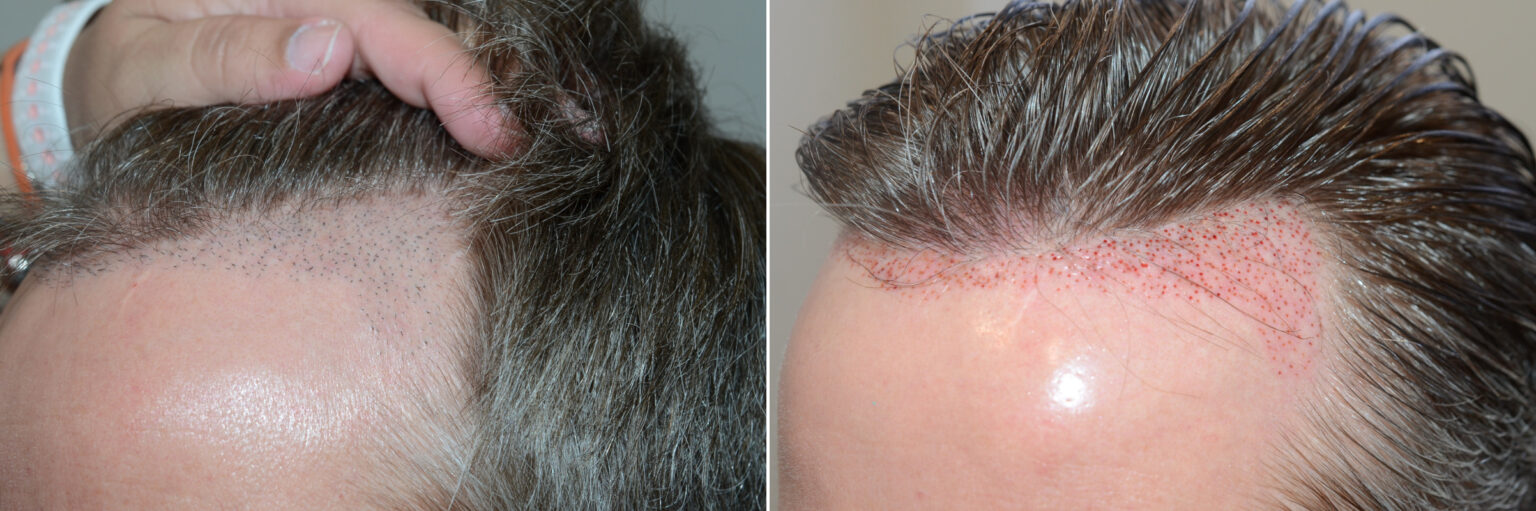 Reparative Hair Transplant Before And After Photos Foundation For