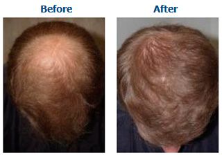 Baldness And Bald Spots Treatments