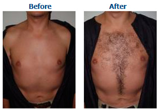 Body Hair Transplant | Miami, FL