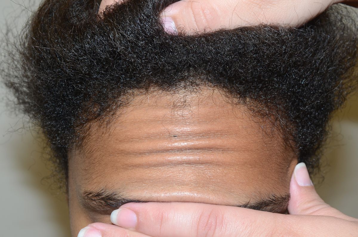 Hairline Advancement Hairline Transplant Miami Fl