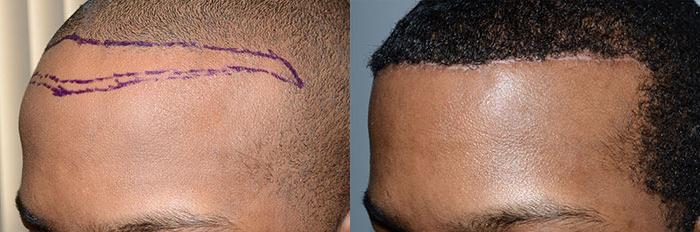 patient-37340-hairline-advancement-before-after-4.jpg