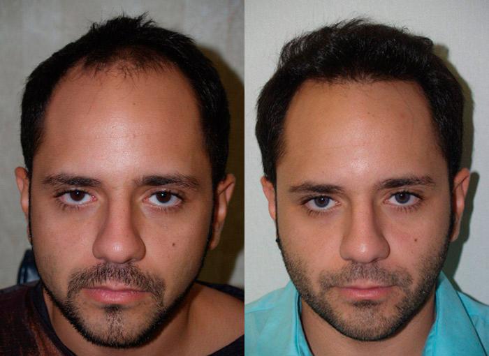 Hair Transplants for Men Photos | Miami, FL | Patient 37531