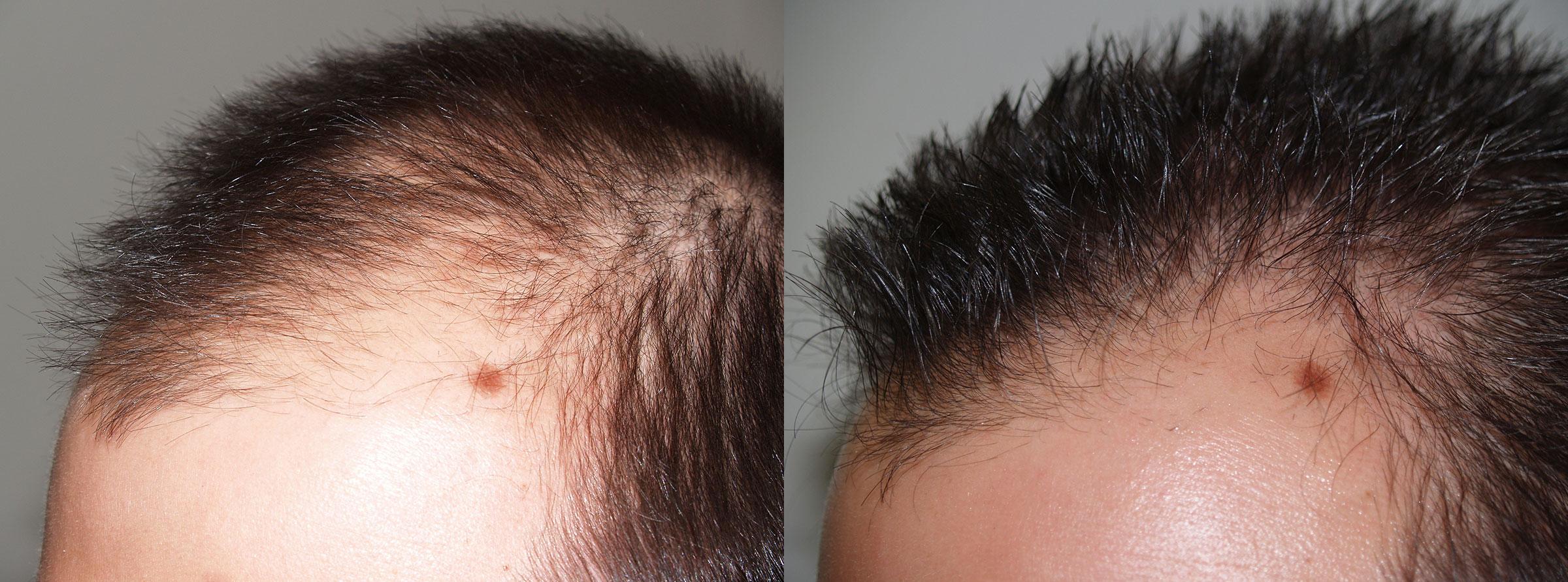 Hair Transplants for Men Photos | Miami, FL | Patient 47570