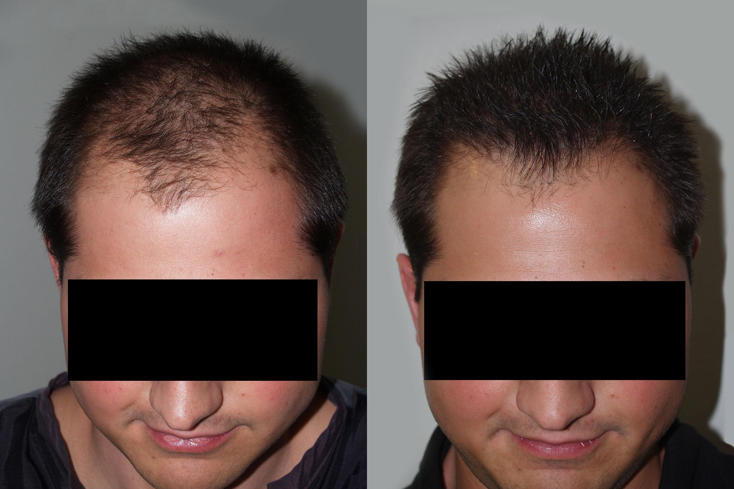 Hair Transplants For Men Photos Miami Fl Patient 47570