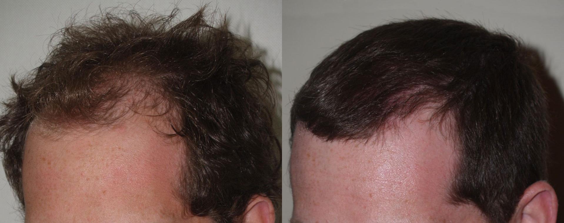 Hair Transplants for Men Photos | Miami, FL | Patient 47581