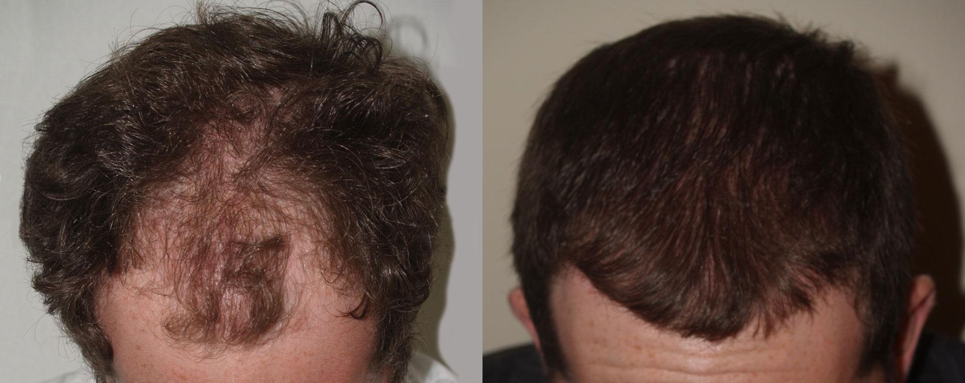 Hair Transplants for Men Photos Miami, FL Patient 47581