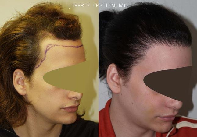 Transgender Hair Transplant Before and After Photos - Foundation