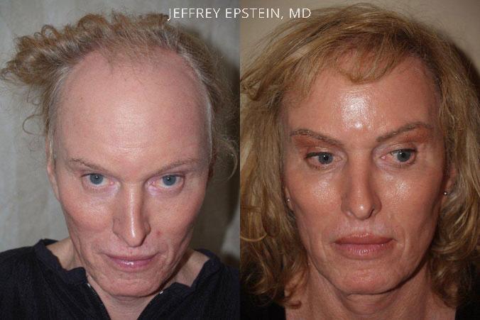 Hair Transplants For Gender Reaffirmation Before And After Photos