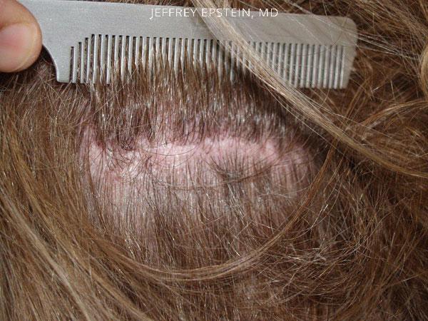 Patient 41320 Foundation For Hair Restoration