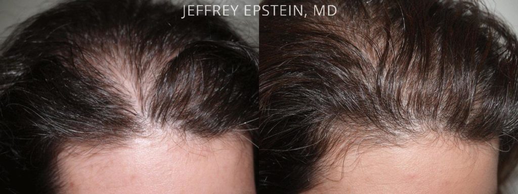 Hair Transplants For Women Photos Miami Fl Patient41821