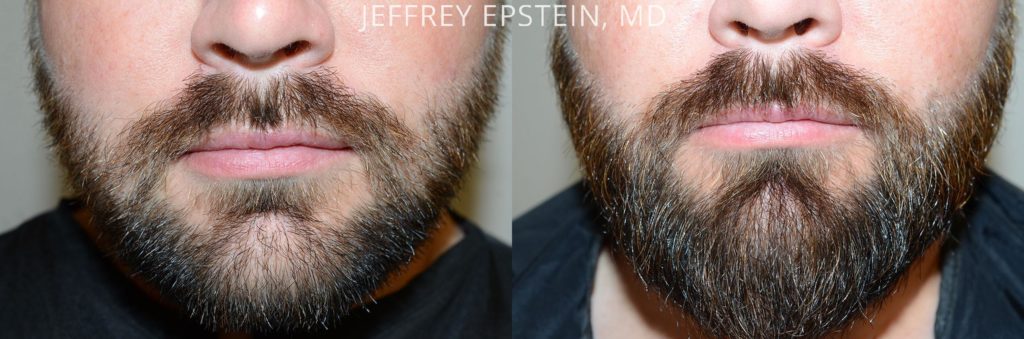 Facial Hair Transplant photos | Miami, FL | Patient47594