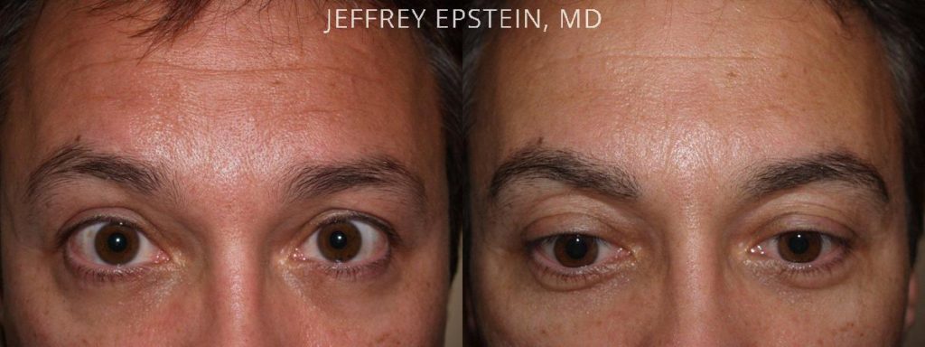 Eyebrow Hair Transplant Photos Miami Fl Patient35796