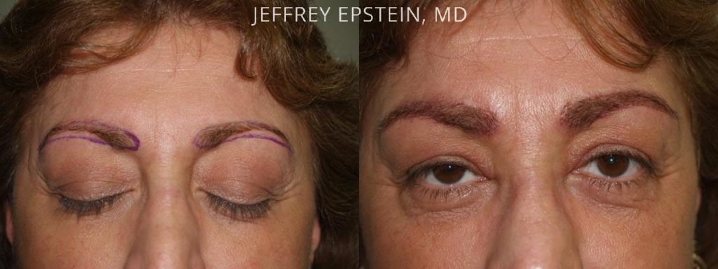 Eyebrow Hair Transplant Photos Miami Fl Patient35954