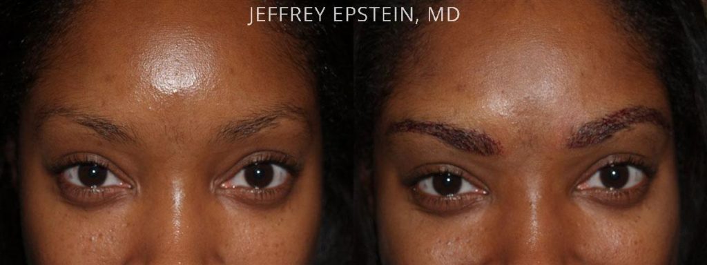 Eyebrow Hair Transplant Photos Miami Fl Patient35995 9928