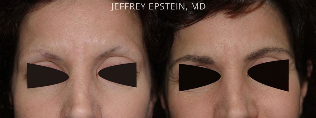 Eyebrow Hair Transplant Photos Miami Fl Patient36002 6773