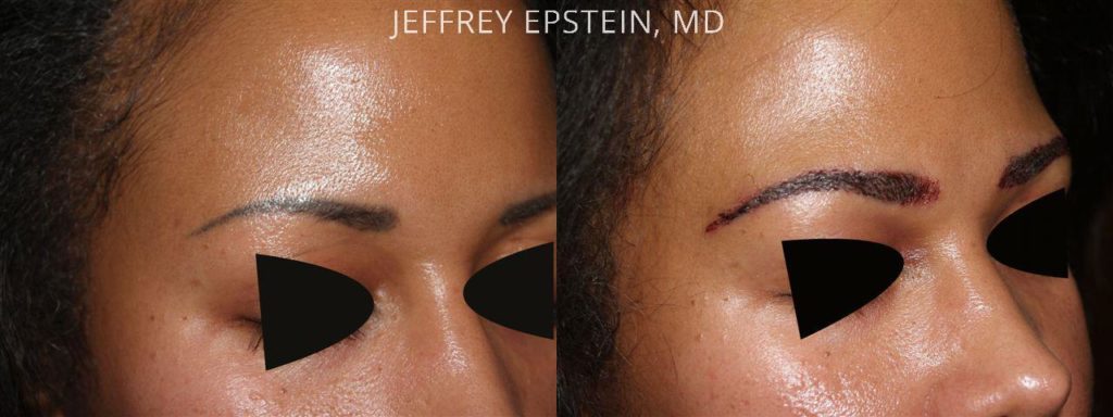 Eyebrow Hair Transplant Photos Miami Fl Patient36023 7959