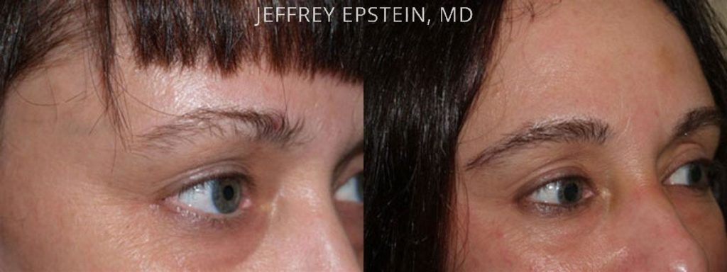 Eyebrow Hair Transplant Photos Miami Fl Patient36039