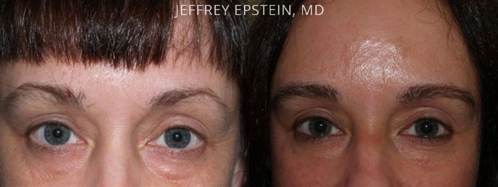 Eyebrow Hair Transplant Photos Miami Fl Patient36039