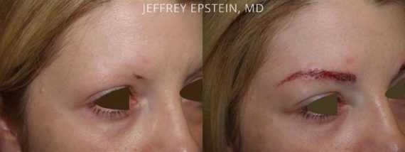 Eyebrow Hair Transplant Before and after in Miami, FL, Paciente 36066