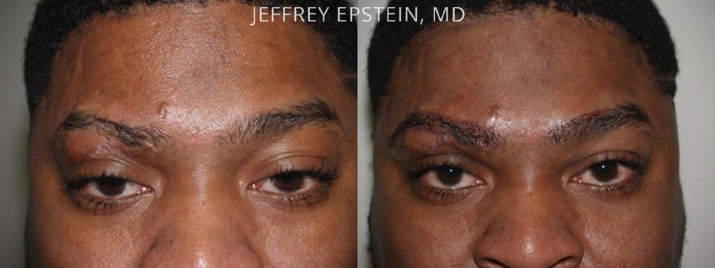 Eyebrow Hair Transplant Photos Miami Fl Patient36107