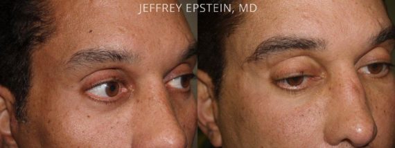 Trasplante de Cejas Before and after in Miami, FL, Paciente 68580