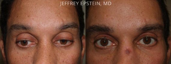 Trasplante de Cejas Before and after in Miami, FL, Paciente 68580