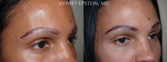 Trasplante de Cejas Before and after in Miami, FL, Paciente 68543