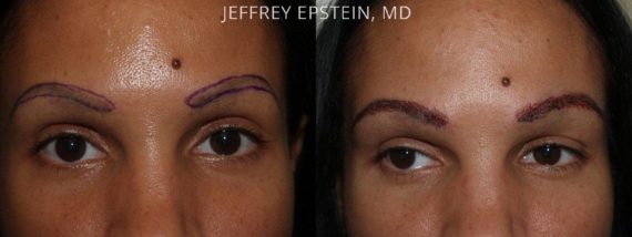 Trasplante de Cejas Before and after in Miami, FL, Paciente 68543