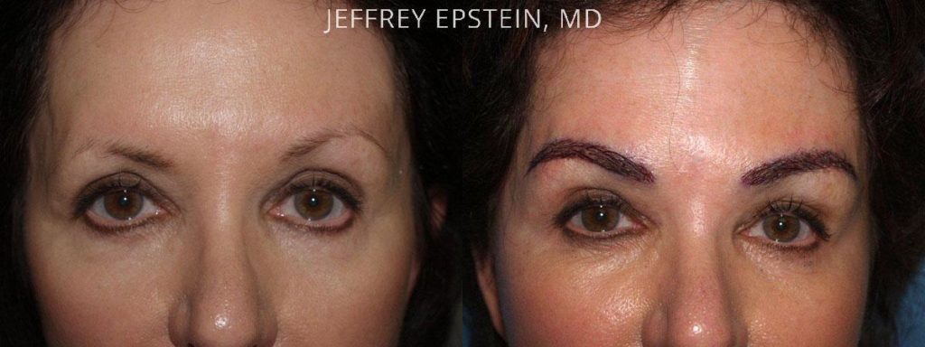 Eyebrow Hair Transplant Photos Miami Fl Patient36269