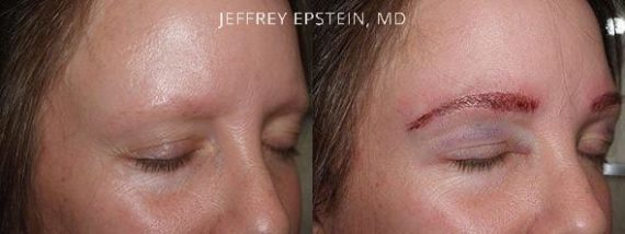 Eyebrow Hair Transplant Before and after in Miami, FL, Paciente 36373