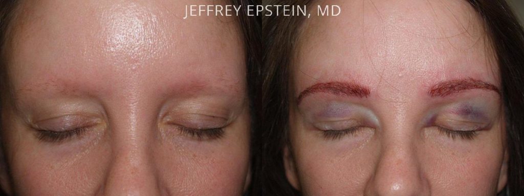 Eyebrow Hair Transplant Photos Miami Fl Patient36373 5258