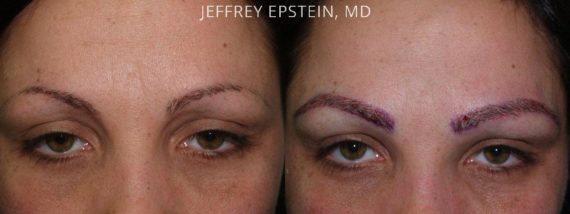 Eyebrow Hair Transplant Before and after in Miami, FL, Paciente 36390