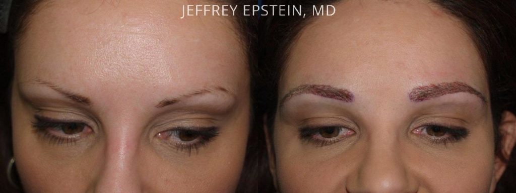 Eyebrow Hair Transplant Photos Miami Fl Patient36397