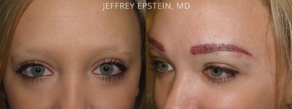 Eyebrow Hair Transplant Before and after in Miami, FL, Paciente 36409