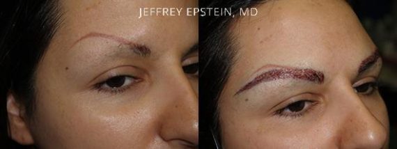 Eyebrow Hair Transplant Before and after in Miami, FL, Paciente 36419