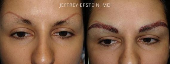 Eyebrow Hair Transplant Before and after in Miami, FL, Paciente 36419