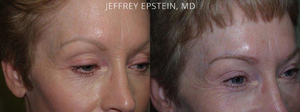 Eyebrow Hair Transplant Photos Miami Fl Patient36429