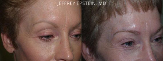 Eyebrow Hair Transplant Before and after in Miami, FL, Paciente 36429