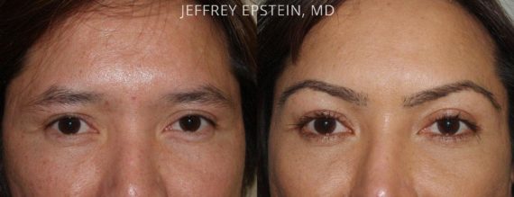 Eyebrow Hair Transplant Before and after in Miami, FL, Paciente 36445