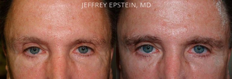 Eyebrow Hair Transplant Photos Miami Fl Patient36594