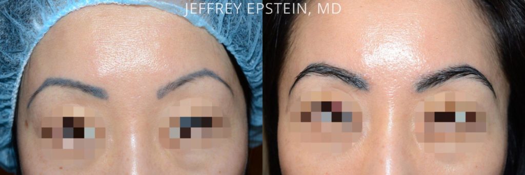 Eyebrow Hair Transplant Photos Miami Fl Patient36677